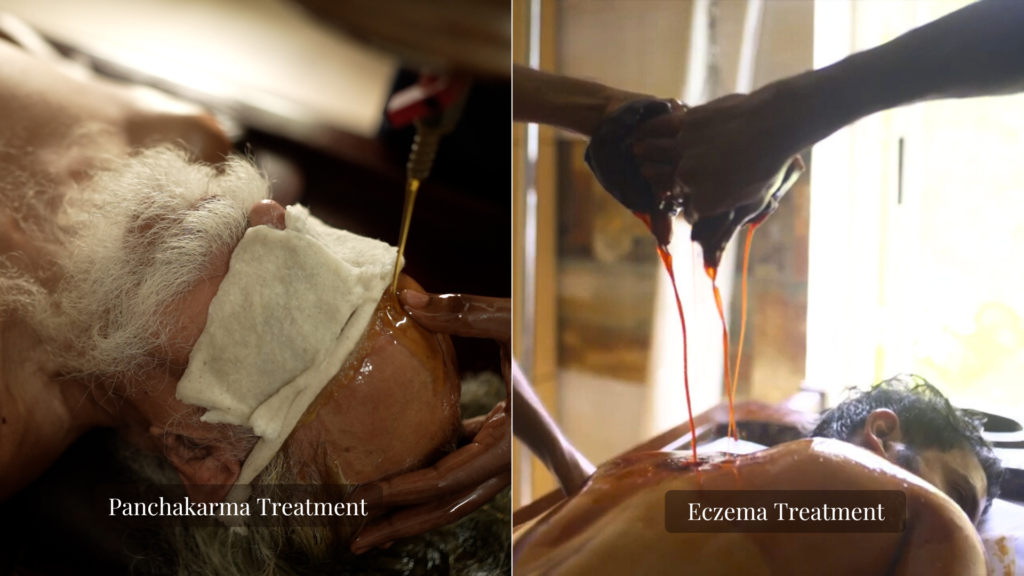 Panchakarma ayurveda treatment for Eczema at VVAC