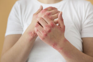 Visit VVAC for the best Ayurveda treatment for Eczema